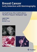 Breast Cancer: Early Detection with Mammography: Crushed Stone-like Calcifications: The Most Frequent Malignant Type (PDF eBook)